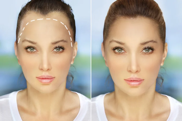 Hair transplant success rate for women