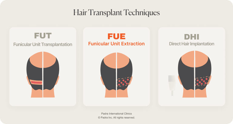 hair transplant techniques