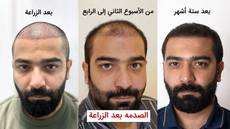 الصدمة بعد زراعة الشعر