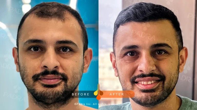 تكثيف الشعر بالزراعة