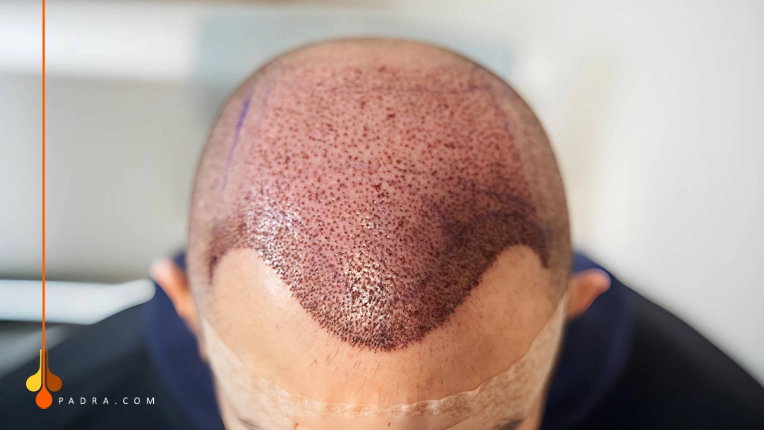 العناية بالبصيلات بعد زراعة الشعر 
