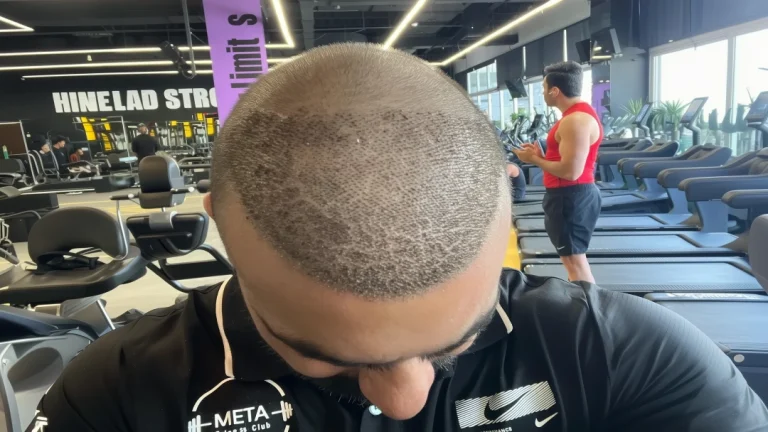 remove scabs after-hair transplant