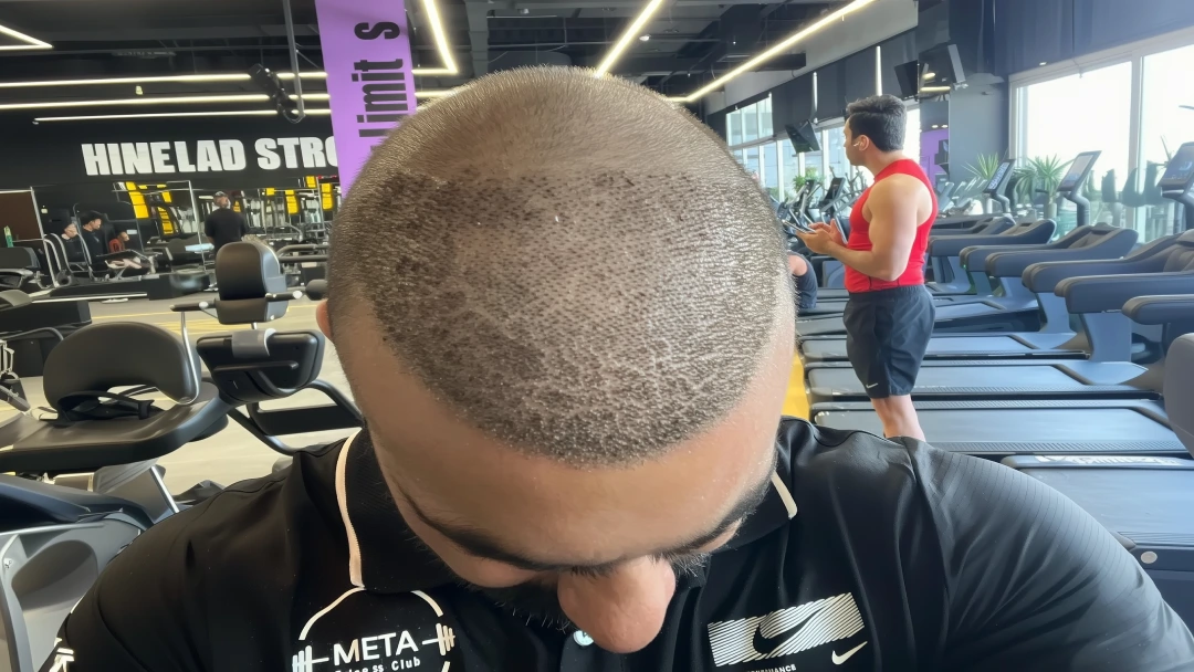 remove scabs after-hair transplant