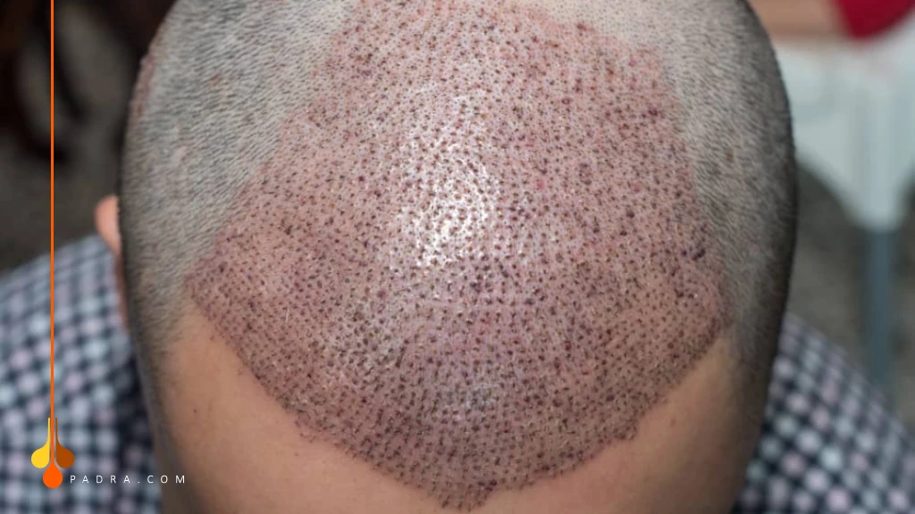 البصيلات في الأسبوع الأول 