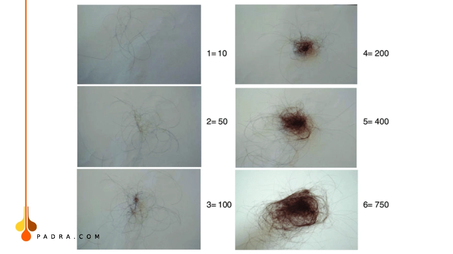 مدى تساقط الشعر الطبيعي و الغيرطبيعي