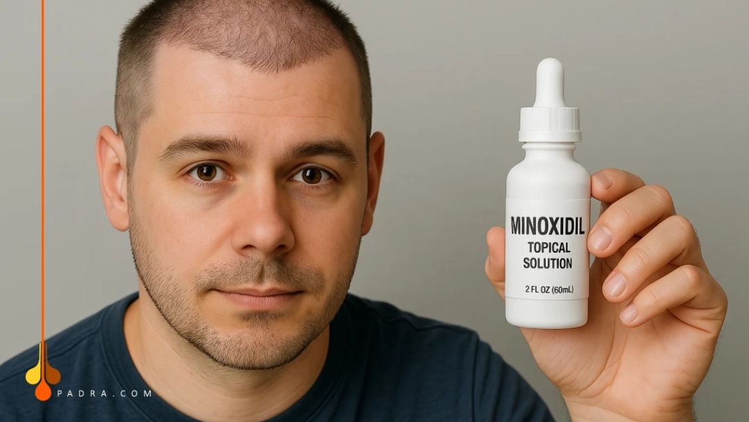 minoxidil after hair transplant
