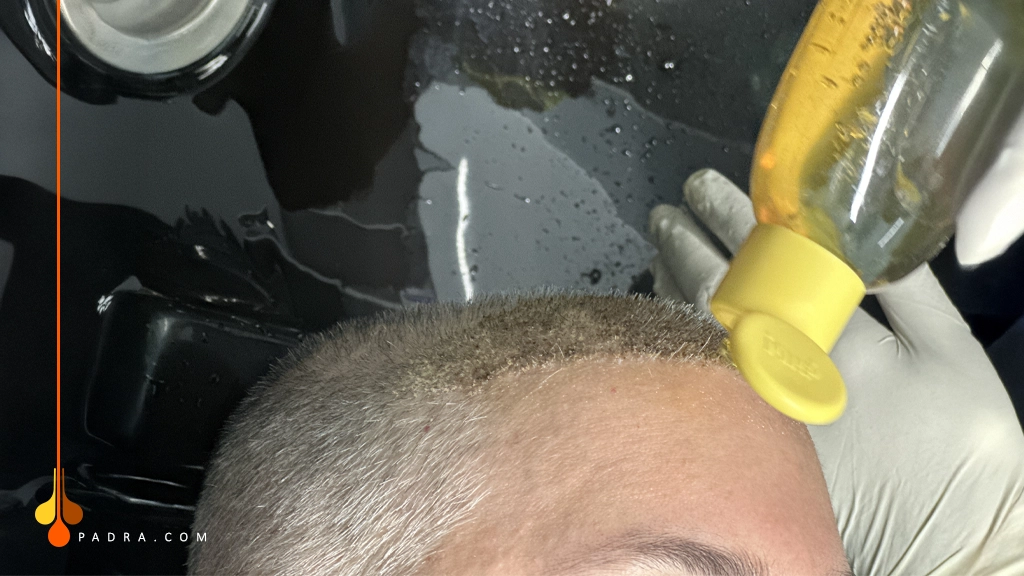 غسل الشعر و ازالة الفشور