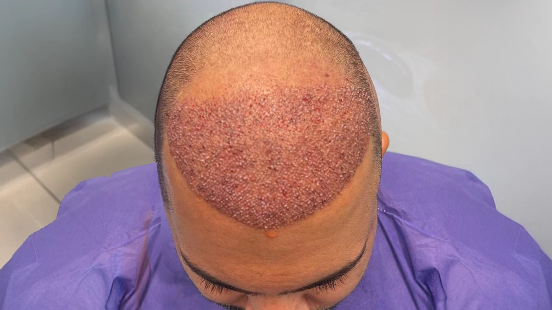 متی تثبت البصیلات بعد زراعة الشعر