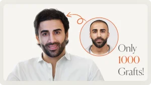 1000 grafts hair transplant