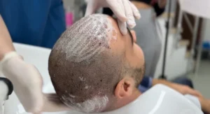 خطوات ونصائح غسل الشعر بعد زراعة الشعر