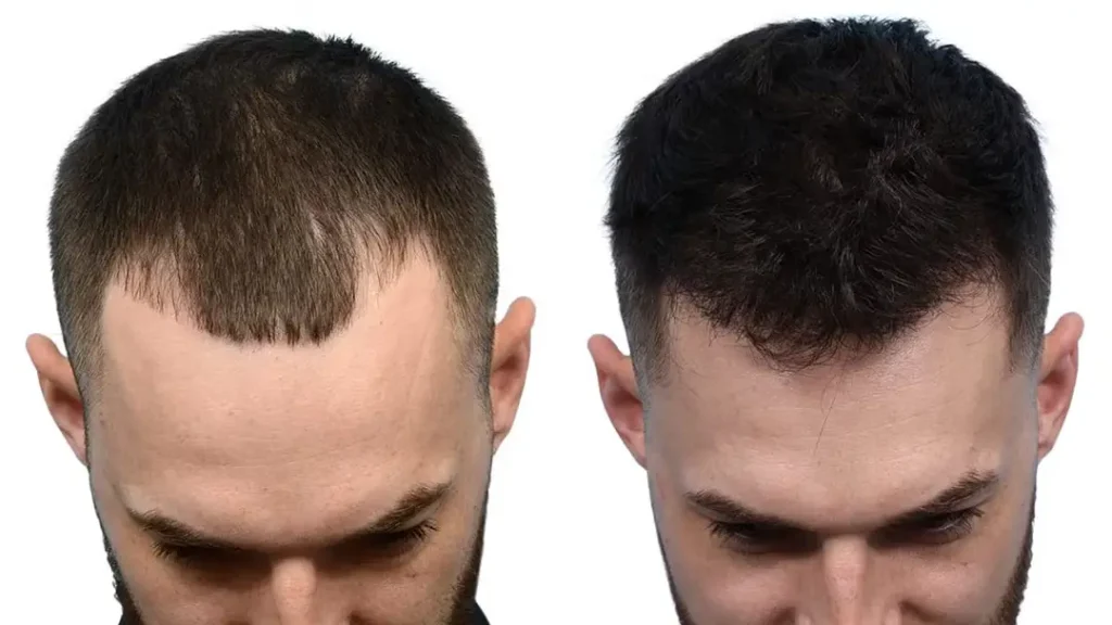 how to get natural looking hair transplant