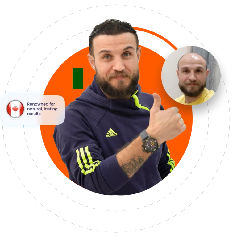 زراعة الشعر في دبي