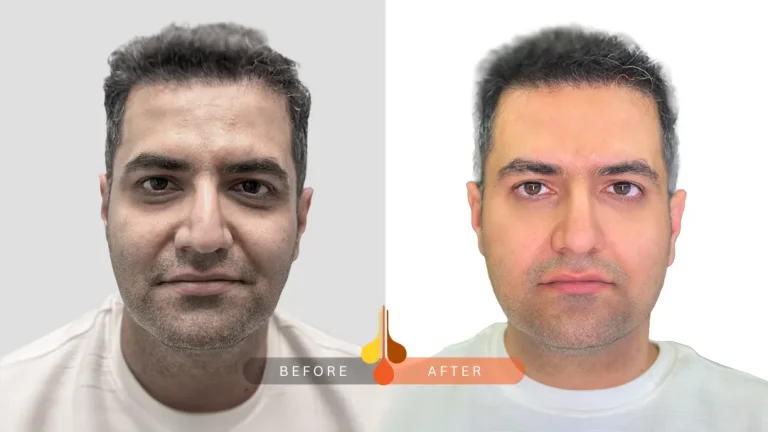 صور قبل و بعد فیلر للهالات السوداء