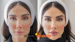 كيف يؤثر فيلر الشفايف للمتزوجات على العلاقة الزوجية؟