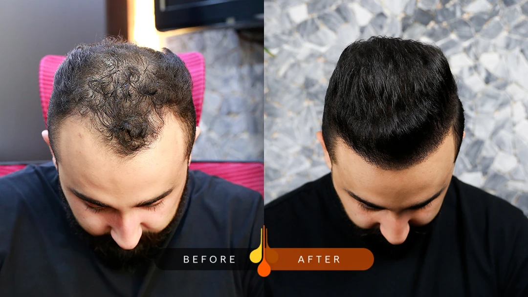 نموذج من زراعة الشعر بشکل V فی بادرا