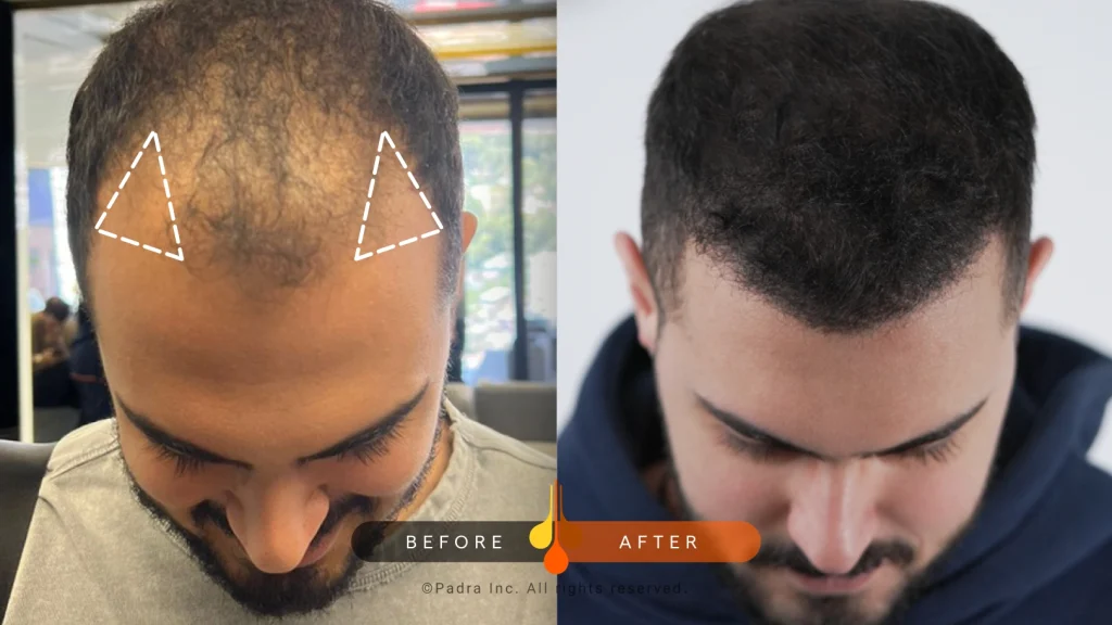 تاثير زراعة الشعر في الصدغين علي الوجه