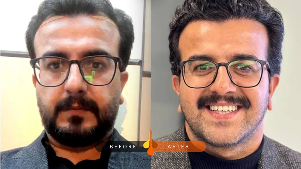 زراعة الشعر للصدغين في بادرا