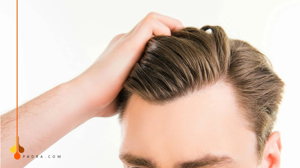 زراعة الشعر للصدغين