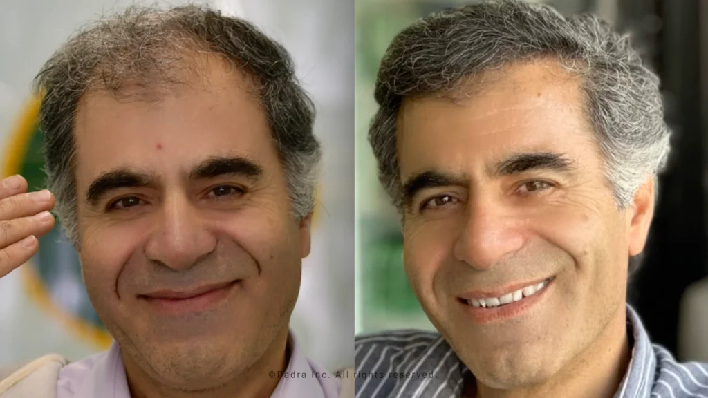 زراعة الشعر للصدغين