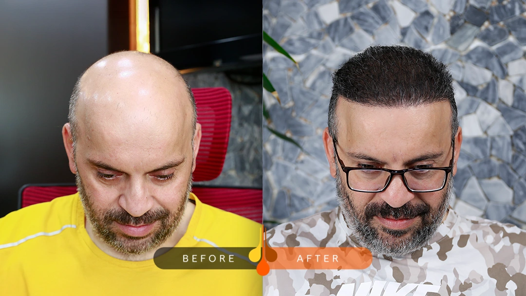 زراعة الشعر للصلع الكامل