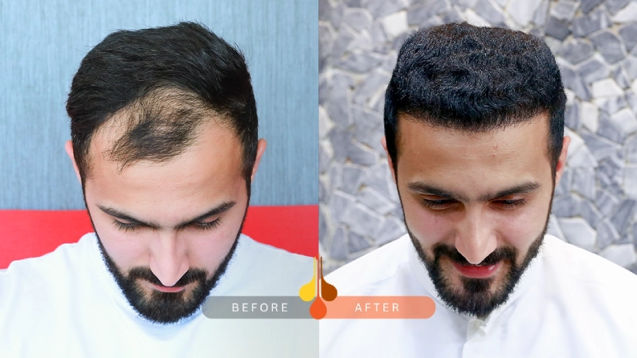 زراعة الشعر حل نهايي للصلع المبكر