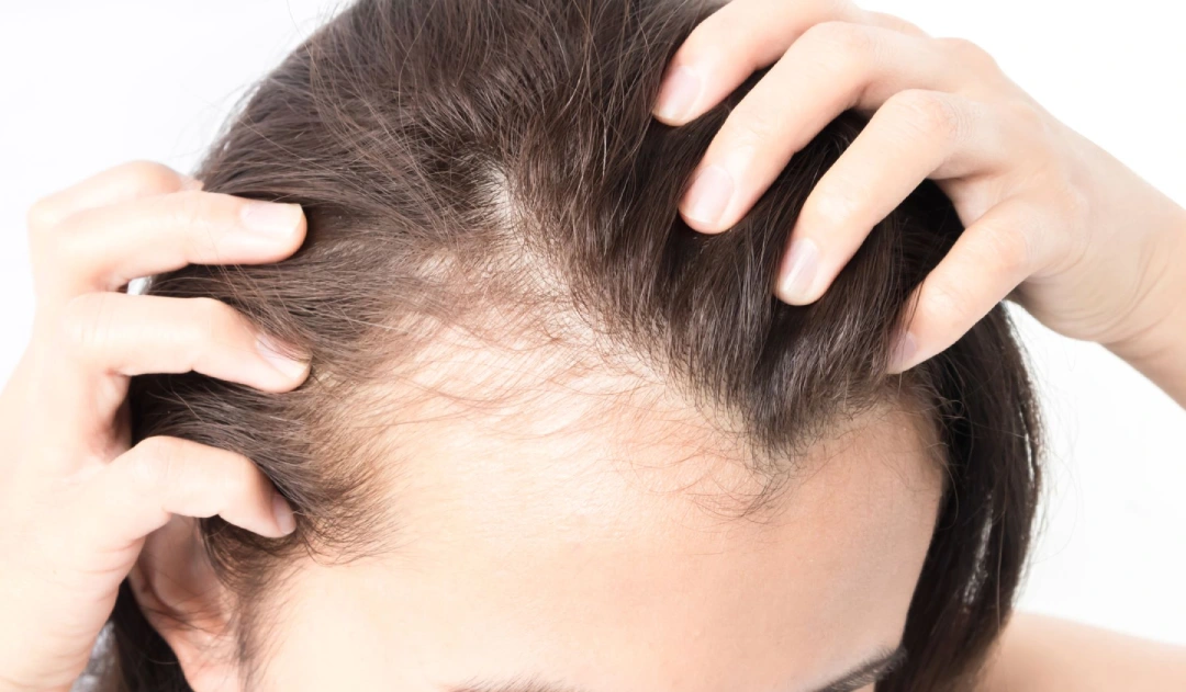 فراغات الشعر في مقدمة الراس النساء