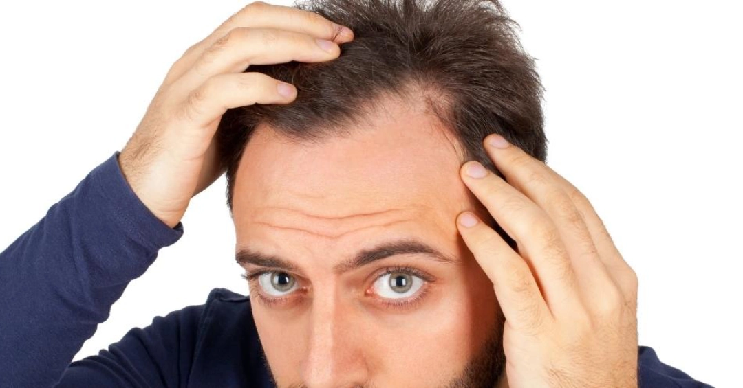 زراعة خط الشعر الامامي V شكل