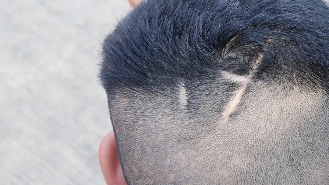 زراعة الشعر علي الندبات