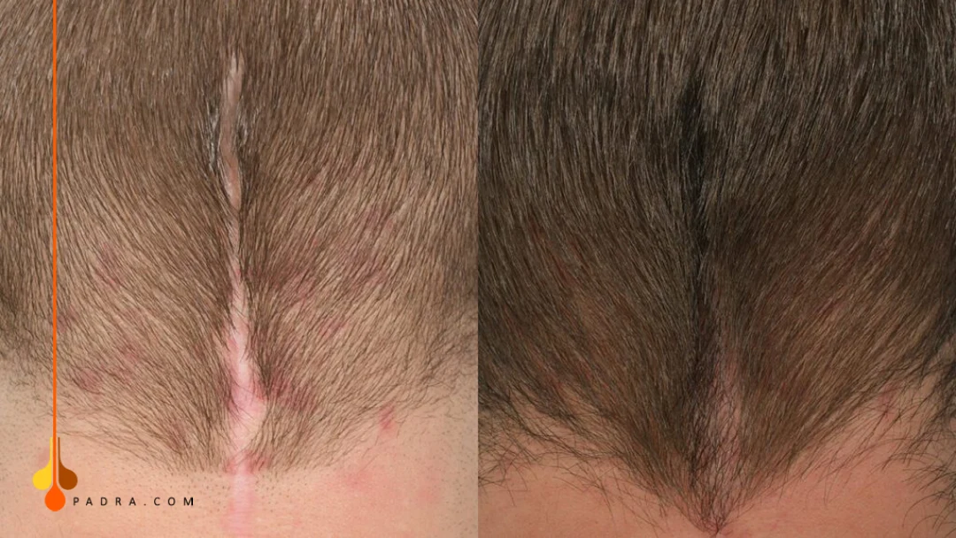 كيف يتم تغطية الندبات بزرع الشعر