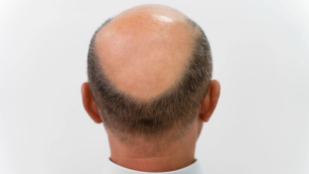 زراعة الشعر عند صلع الكامل