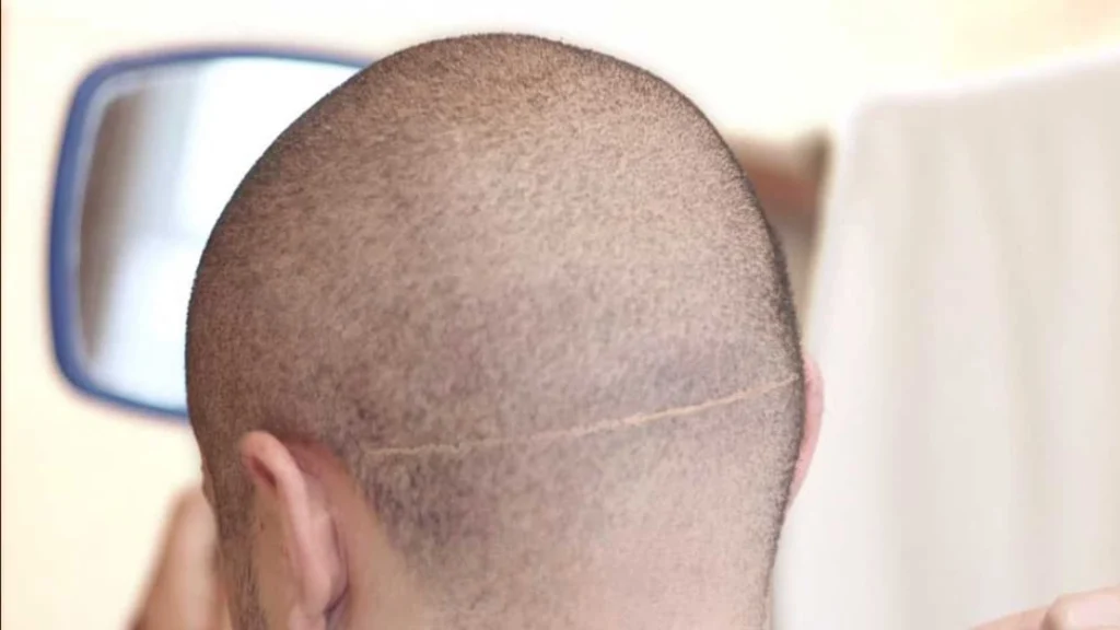 الندوب بعد زراعة الشعر