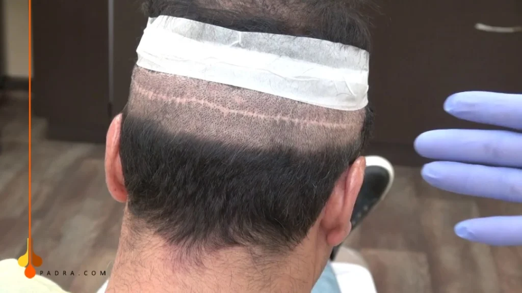 ندوب تبقي بعد زراعة الشعر بتقنية FUT