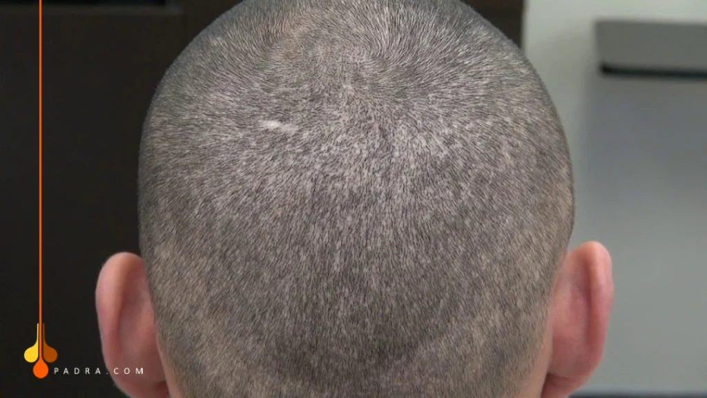 ندبات بعد زراعة الشعر 