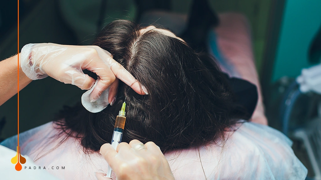 حقن البلازما لتساقط الشعر 