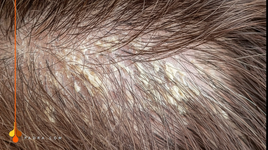 الإكزيما الدهنية