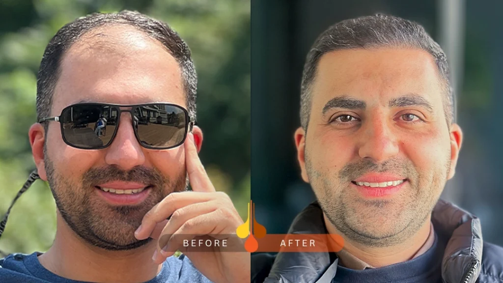 علاج الصلع الوراثي بزراعة الشعر