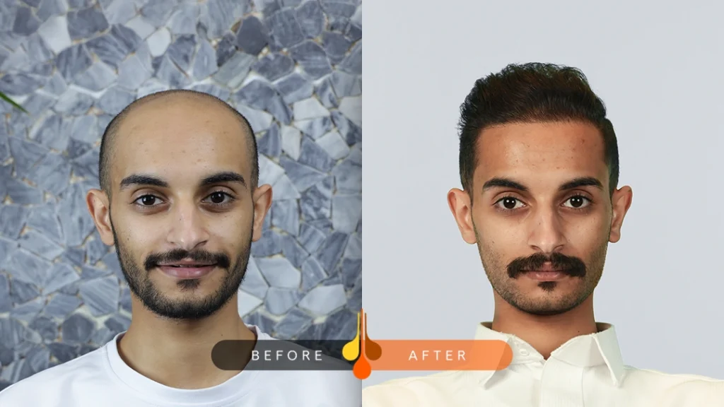 دوام  نتايج زراعة الشعر بعد كم سنة 