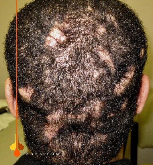 الصلع الندبي نوع الأول