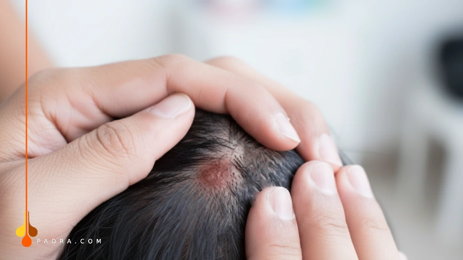 الدمامل في الراس