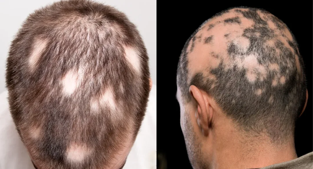 صورة للصلع الندبي