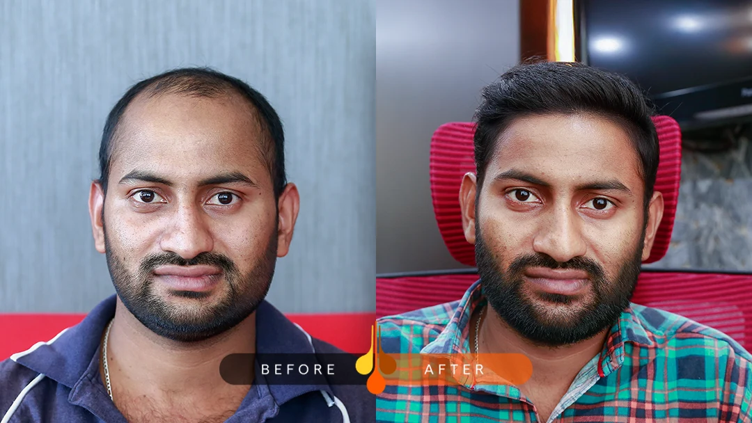 زراعة الشعر بتقنية FUE