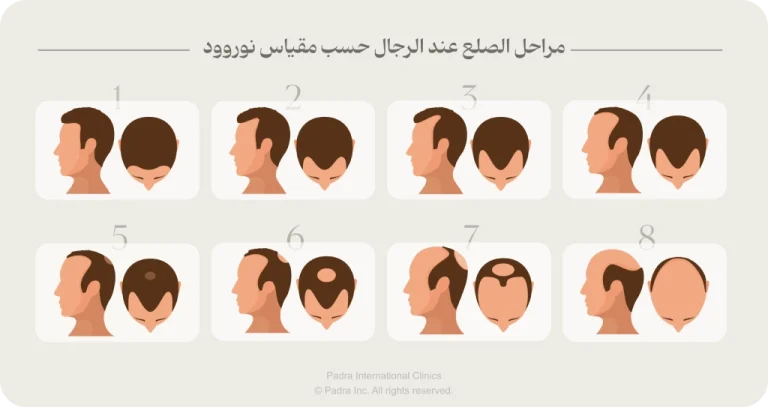 مراحل الصلع عند الرجال