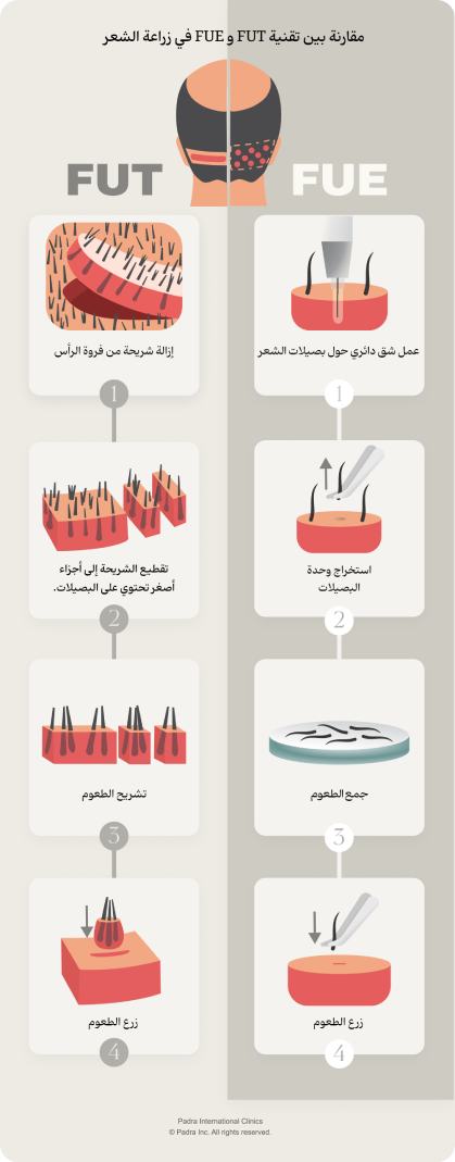 قياس تقنيتين زراعة الشعر FUE و FUT