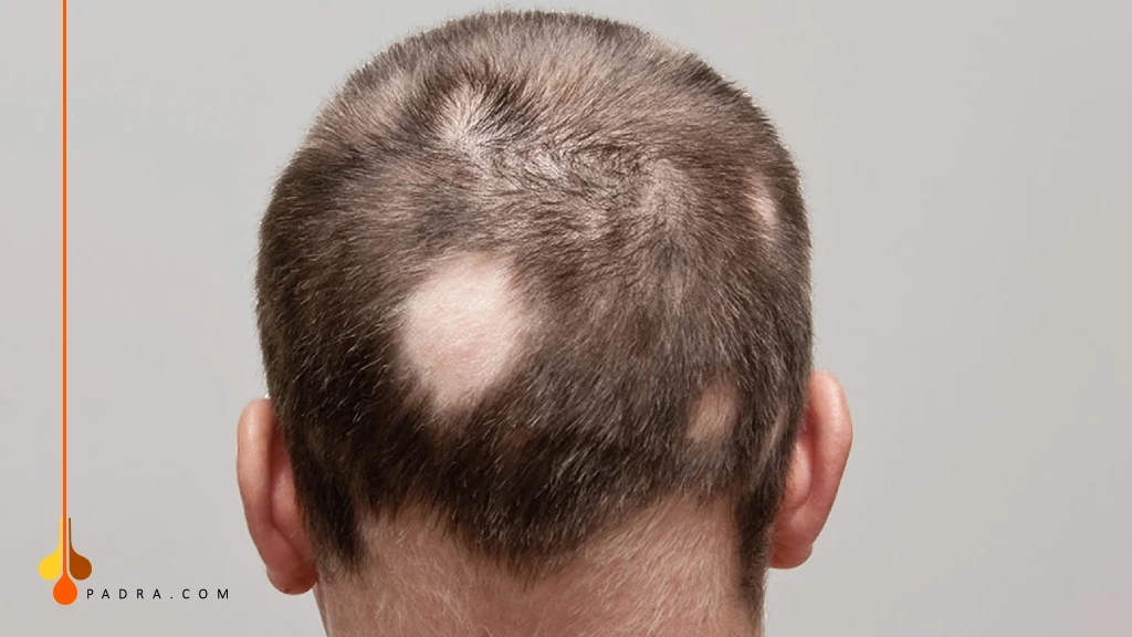 تساقط الشعر الثعلبة البقعية