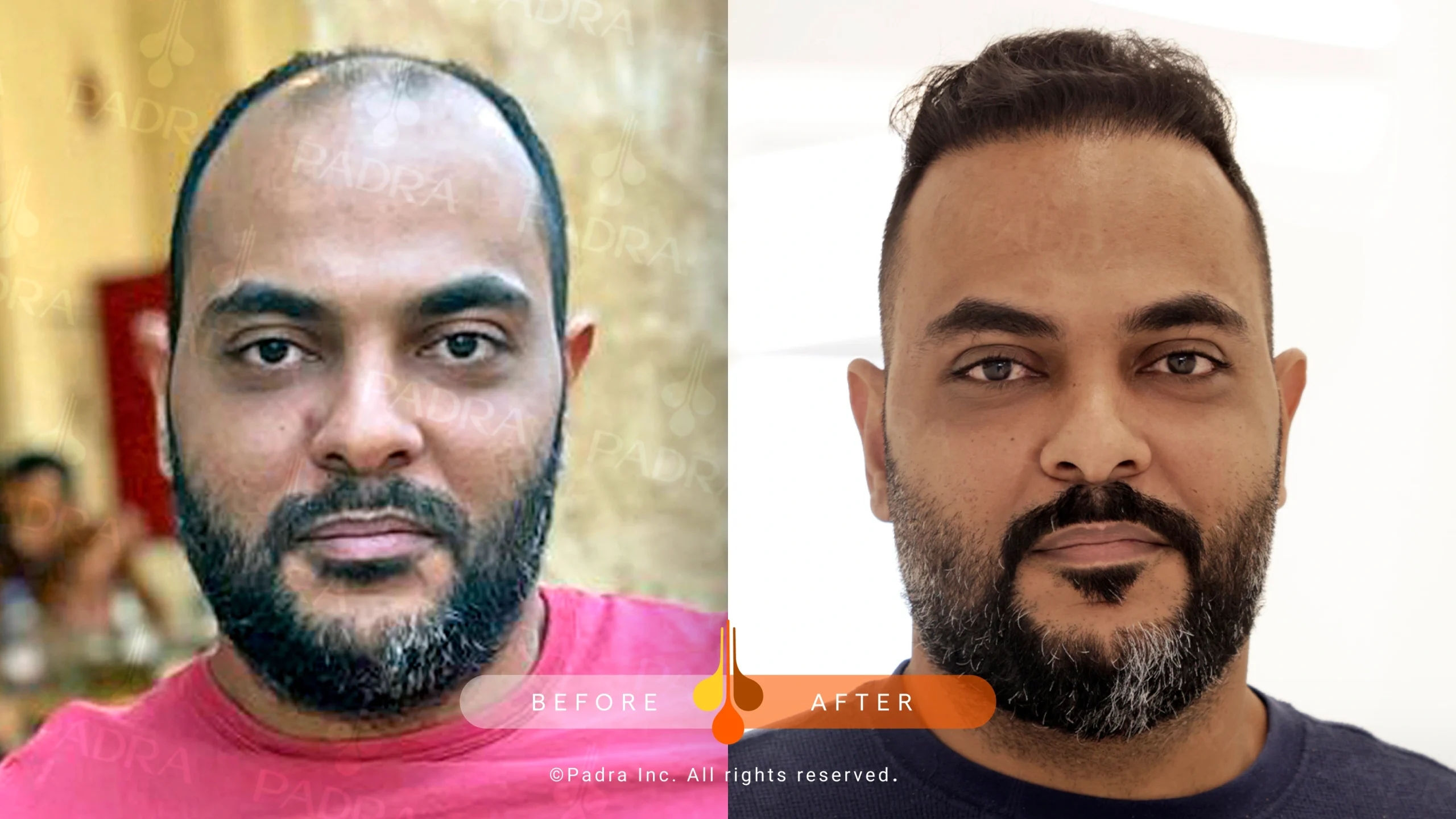 صور قبل و بعد في بادرا السعودية