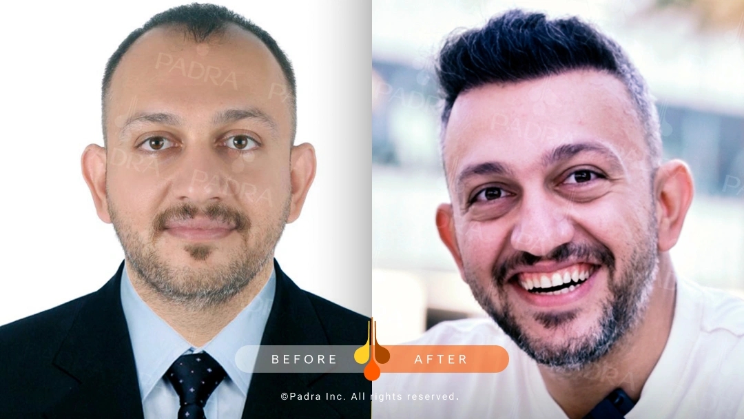 صور قبل و بعد في بادرا السعودية