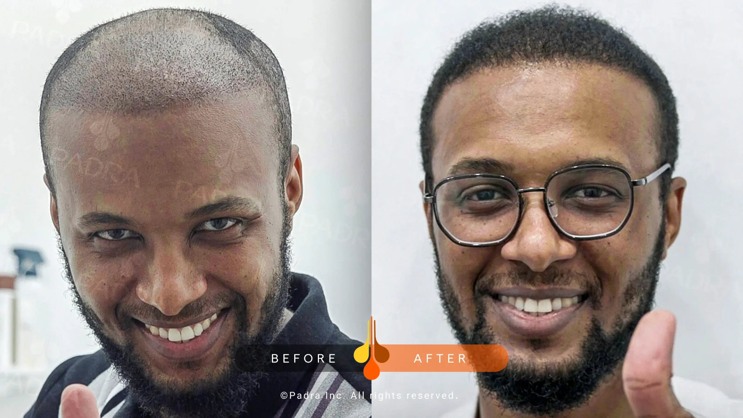 صور قبل و بعد في بادرا السعودية