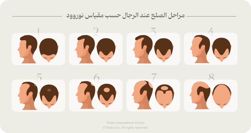 مراحل الصلع عند الرجال و النساء