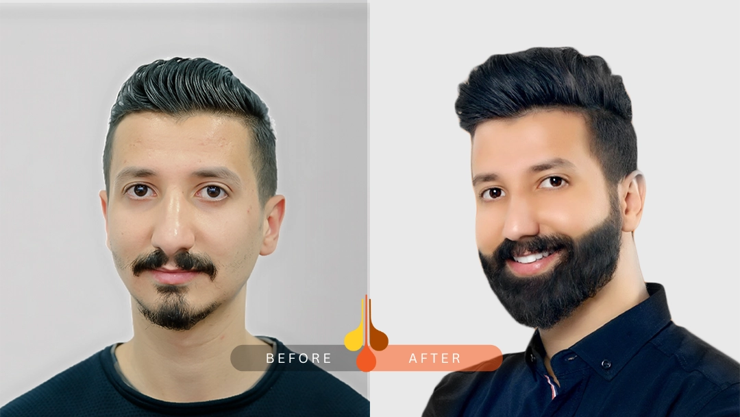 beard transplant Dubai before and after