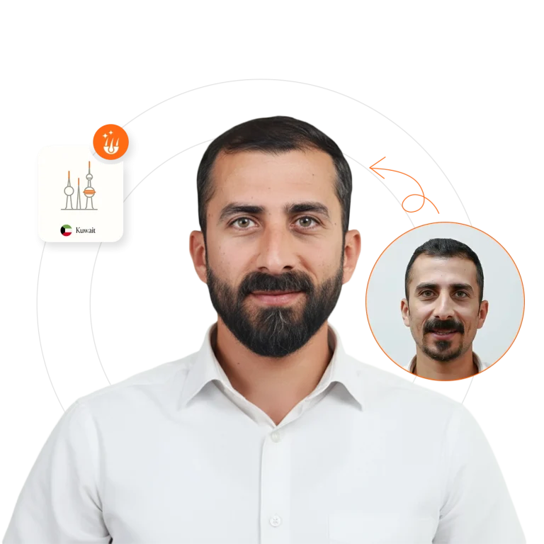 Beard & Moustache Transplant in Kuwait